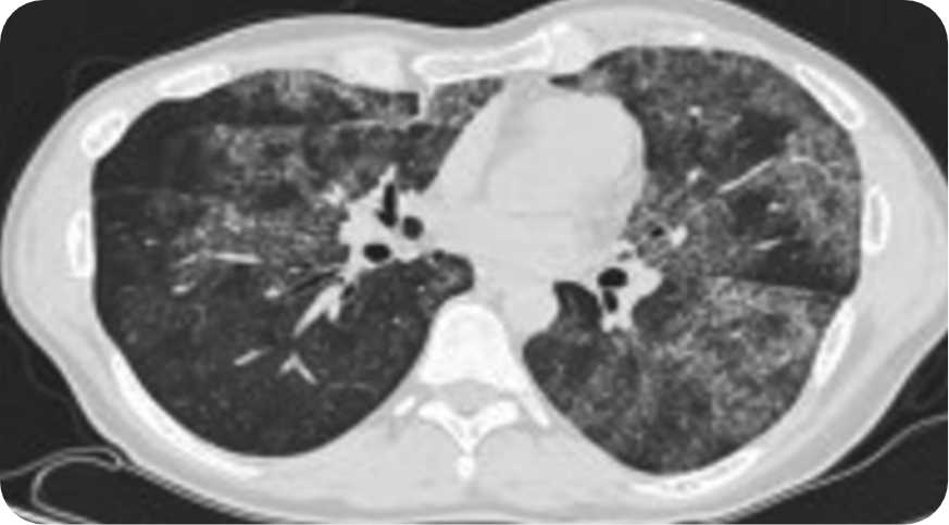 lung with crazy paving on CT scan