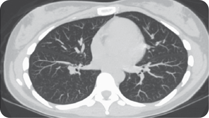 normal lung CT scan