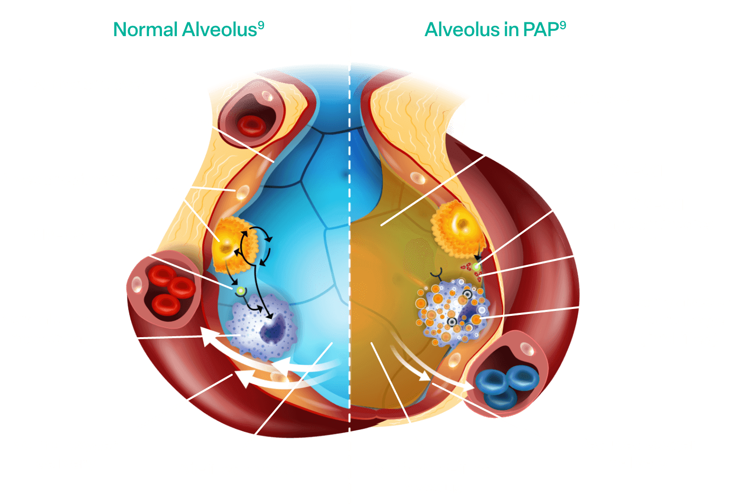 A side-by-side of normal alveolus vs alveolus with aPAP. With aPAP, the alveolus has a thicker surfactant layer, a lipid filled alveolar macrophage, reduced oxygen delivery and the presence of GM-CSF autoantibodies.