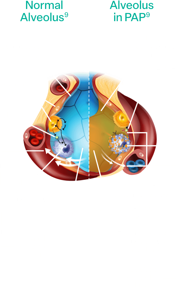 Normal alveolus vs alveolus with aPAP